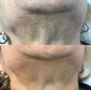 Toddington Laser Clinic hair removal before and after: chin
